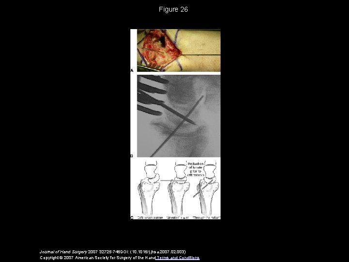 Figure 26 Journal of Hand Surgery 2007 32725 -746 DOI: (10. 1016/j. jhsa. 2007.