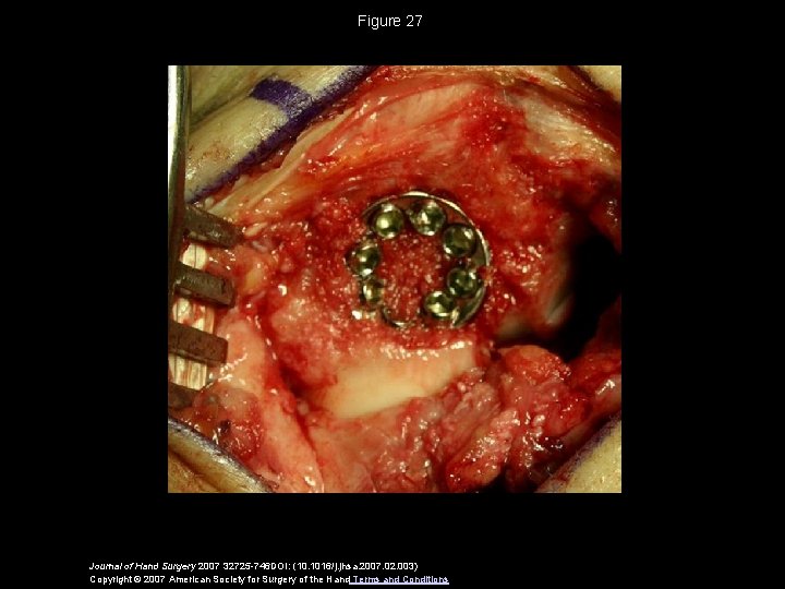 Figure 27 Journal of Hand Surgery 2007 32725 -746 DOI: (10. 1016/j. jhsa. 2007.