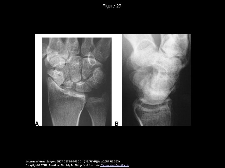 Figure 29 Journal of Hand Surgery 2007 32725 -746 DOI: (10. 1016/j. jhsa. 2007.