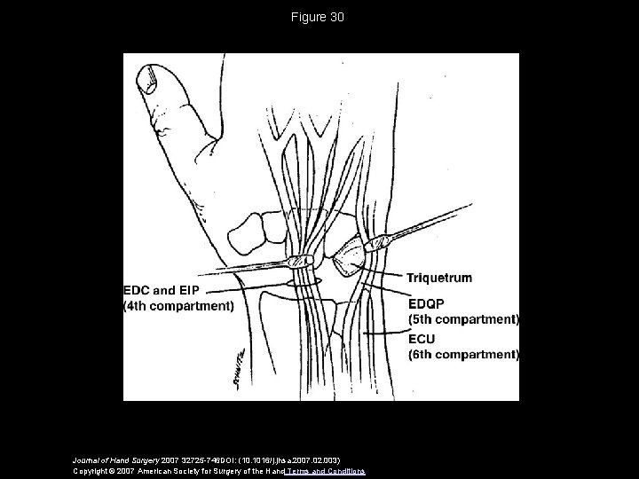 Figure 30 Journal of Hand Surgery 2007 32725 -746 DOI: (10. 1016/j. jhsa. 2007.