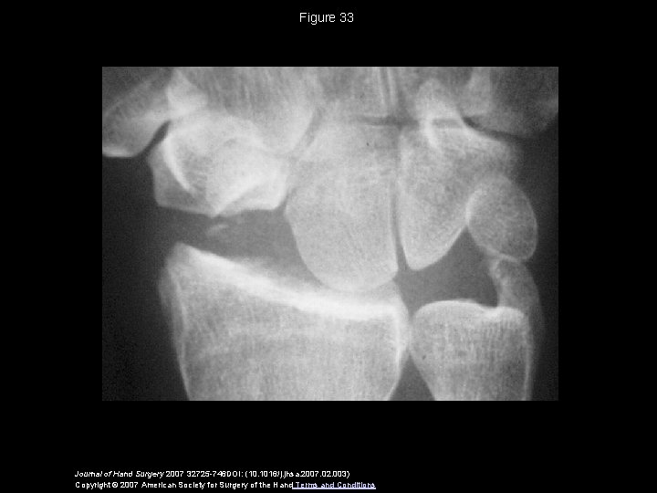 Figure 33 Journal of Hand Surgery 2007 32725 -746 DOI: (10. 1016/j. jhsa. 2007.