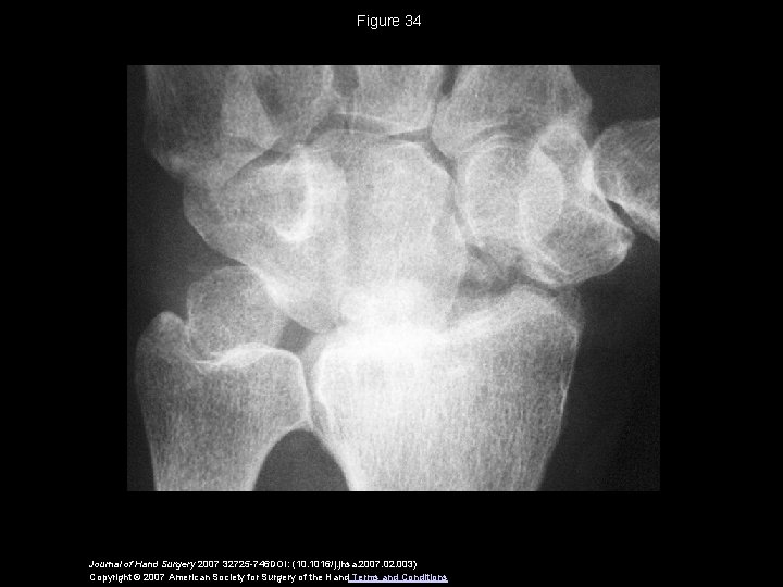 Figure 34 Journal of Hand Surgery 2007 32725 -746 DOI: (10. 1016/j. jhsa. 2007.