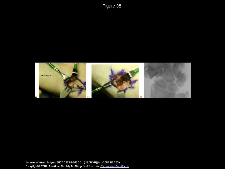 Figure 35 Journal of Hand Surgery 2007 32725 -746 DOI: (10. 1016/j. jhsa. 2007.