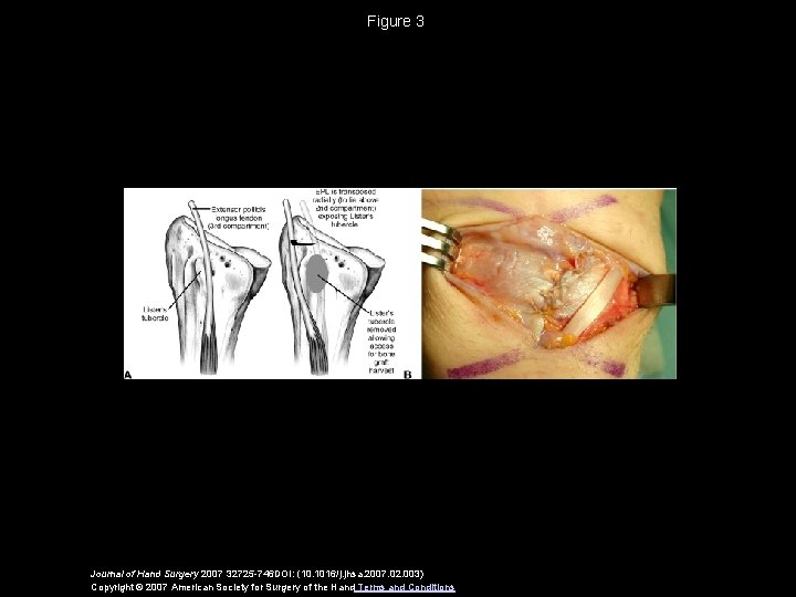 Figure 3 Journal of Hand Surgery 2007 32725 -746 DOI: (10. 1016/j. jhsa. 2007.