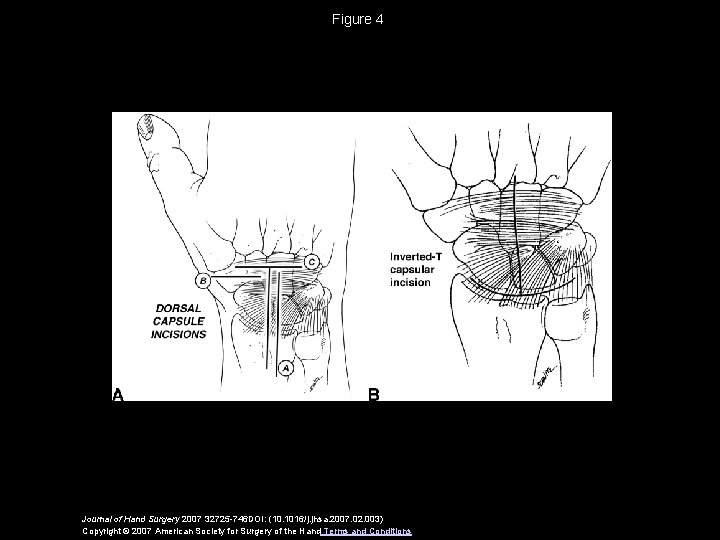 Figure 4 Journal of Hand Surgery 2007 32725 -746 DOI: (10. 1016/j. jhsa. 2007.