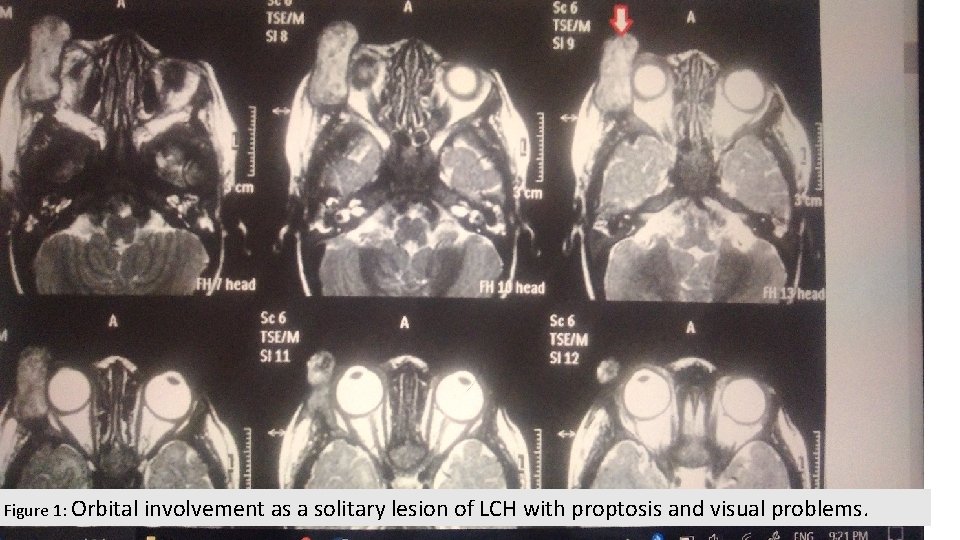 Figure 1: Orbital involvement as a solitary lesion of LCH with proptosis and visual