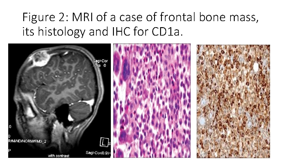 Figure 2: MRI of a case of frontal bone mass, its histology and IHC