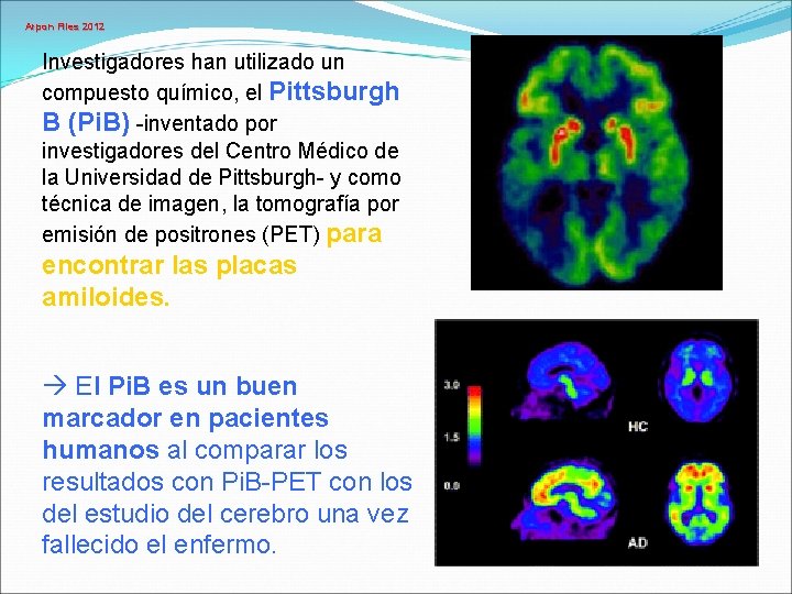 Arpon Files 2012 Investigadores han utilizado un compuesto químico, el Pittsburgh B (Pi. B)