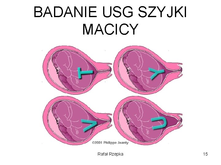 BADANIE USG SZYJKI MACICY Rafał Rzepka 15 