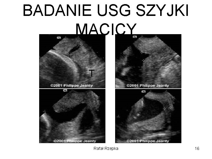 BADANIE USG SZYJKI MACICY T Rafał Rzepka 16 