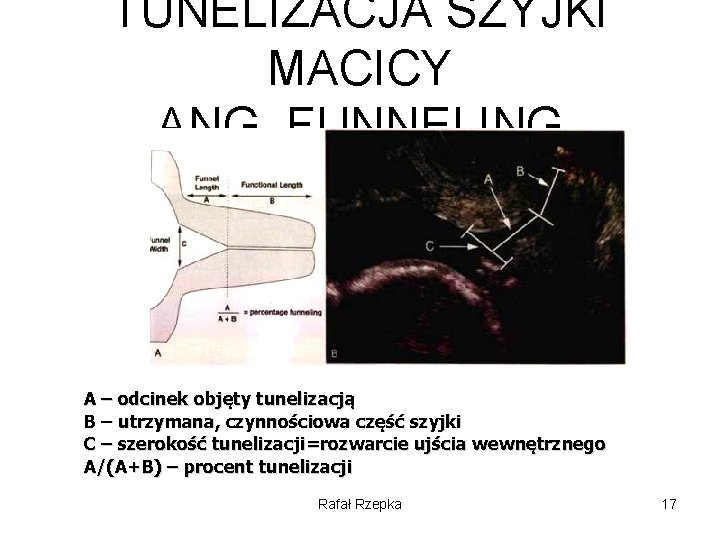 TUNELIZACJA SZYJKI MACICY ANG. FUNNELING A – odcinek objęty tunelizacją B – utrzymana, czynnościowa