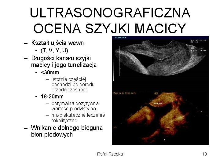 ULTRASONOGRAFICZNA OCENA SZYJKI MACICY – Kształt ujścia wewn. • (T, V, Y, U) –