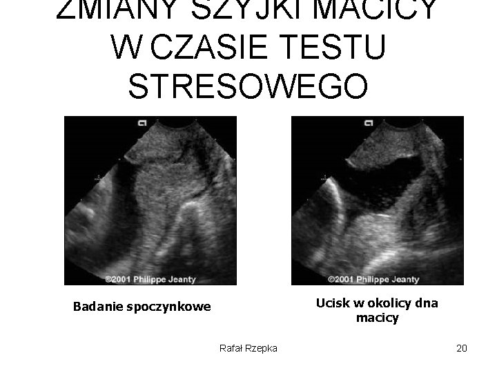 ZMIANY SZYJKI MACICY W CZASIE TESTU STRESOWEGO Ucisk w okolicy dna macicy Badanie spoczynkowe