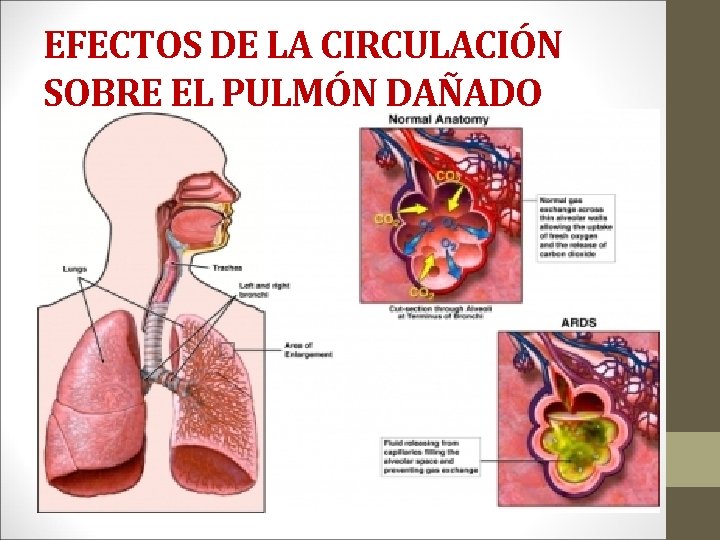 EFECTOS DE LA CIRCULACIÓN SOBRE EL PULMÓN DAÑADO • Perfusión pulmonar y aumento de