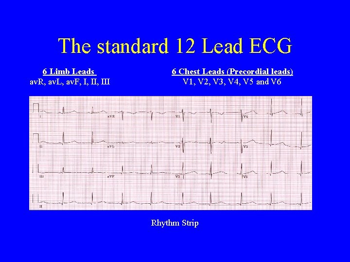 The standard 12 Lead ECG 6 Limb Leads av. R, av. L, av. F,