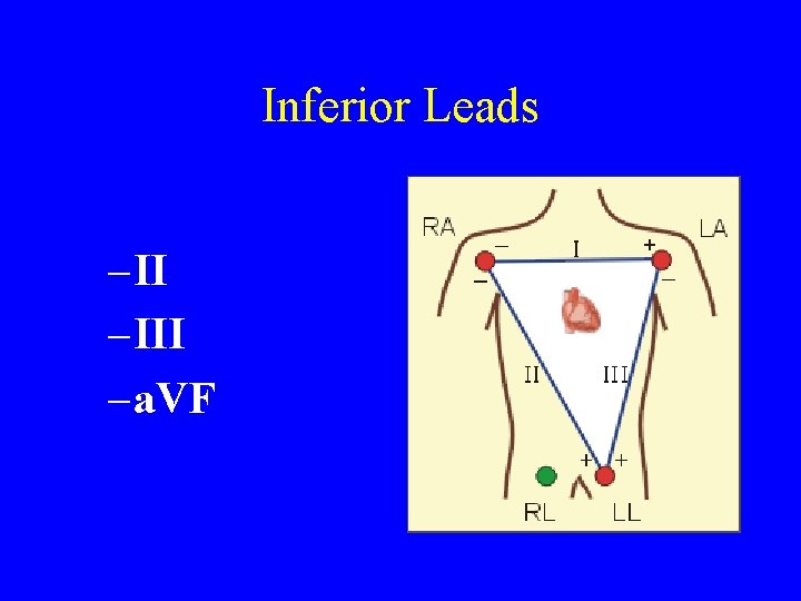 Inferior Leads – III – a. VF 