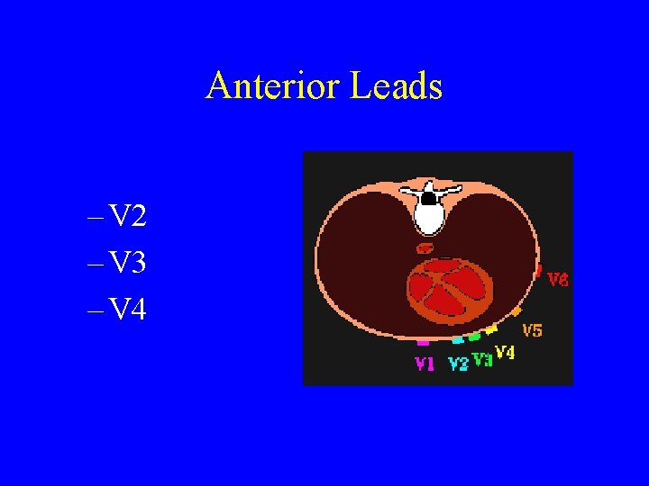 Anterior Leads – V 2 – V 3 – V 4 