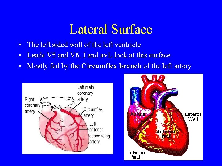 Lateral Surface • The left sided wall of the left ventricle • Leads V