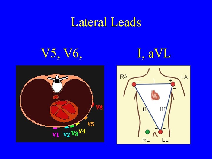 Lateral Leads V 5, V 6, I, a. VL 