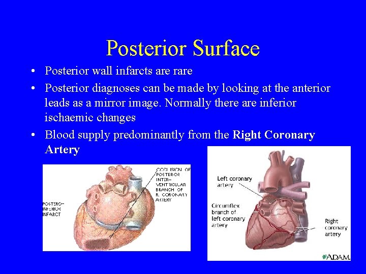 Posterior Surface • Posterior wall infarcts are rare • Posterior diagnoses can be made