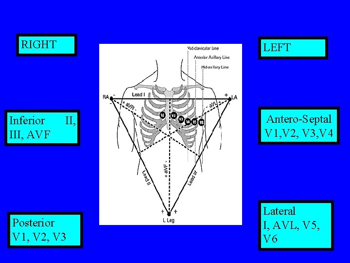 RIGHT Inferior III, AVF LEFT II, Posterior V 1, V 2, V 3 Antero-Septal