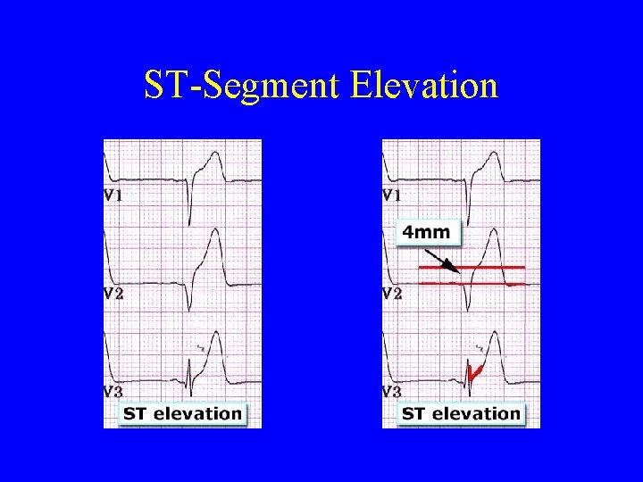 ST-Segment Elevation 