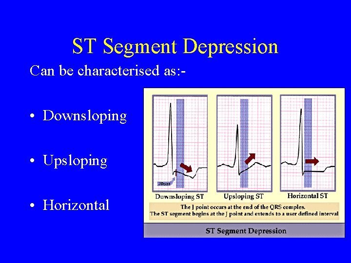 ST Segment Depression Can be characterised as: - • Downsloping • Upsloping • Horizontal