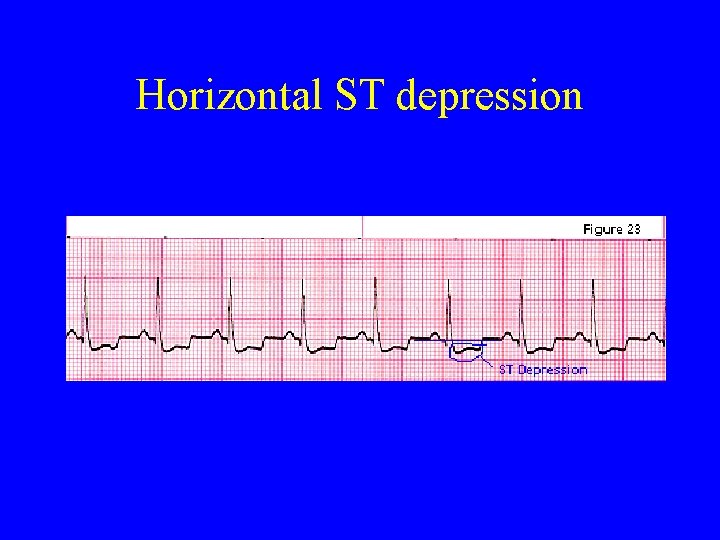 Horizontal ST depression 