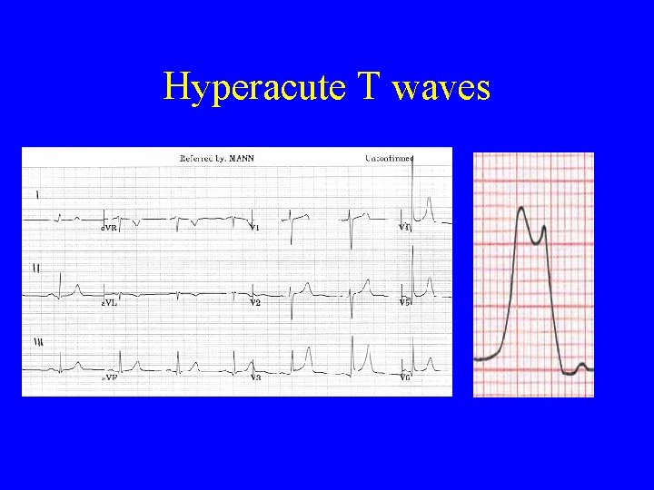 Hyperacute T waves 