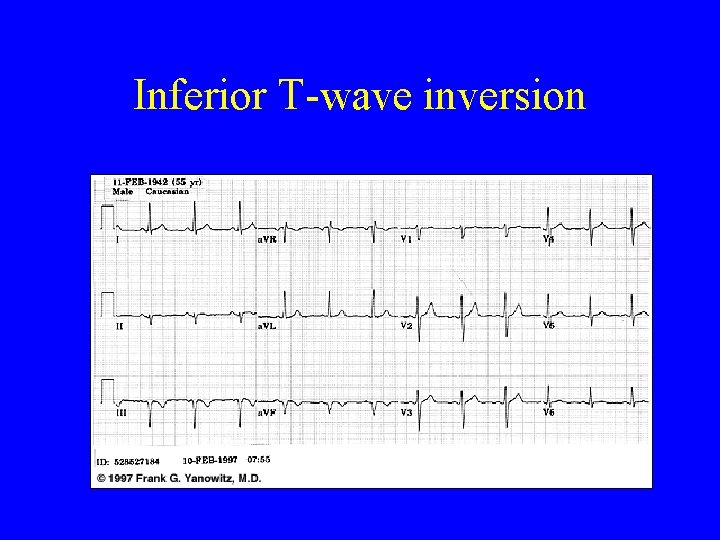 Inferior T-wave inversion 