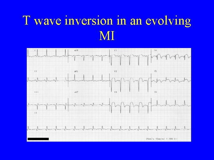 T wave inversion in an evolving MI 