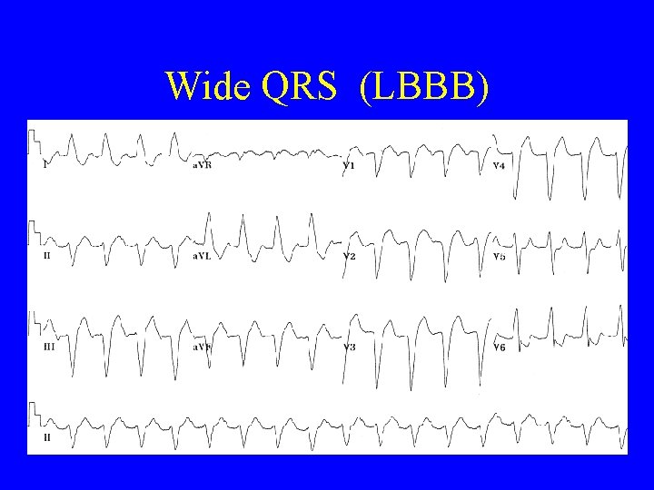 Wide QRS (LBBB) 