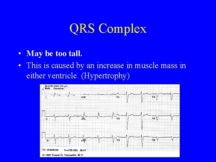 QRS Complex • May be too tall. • This is caused by an increase