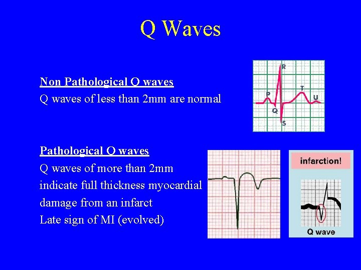 Q Waves Non Pathological Q waves of less than 2 mm are normal Pathological