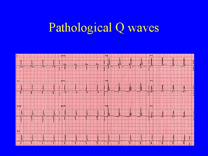 Pathological Q waves 