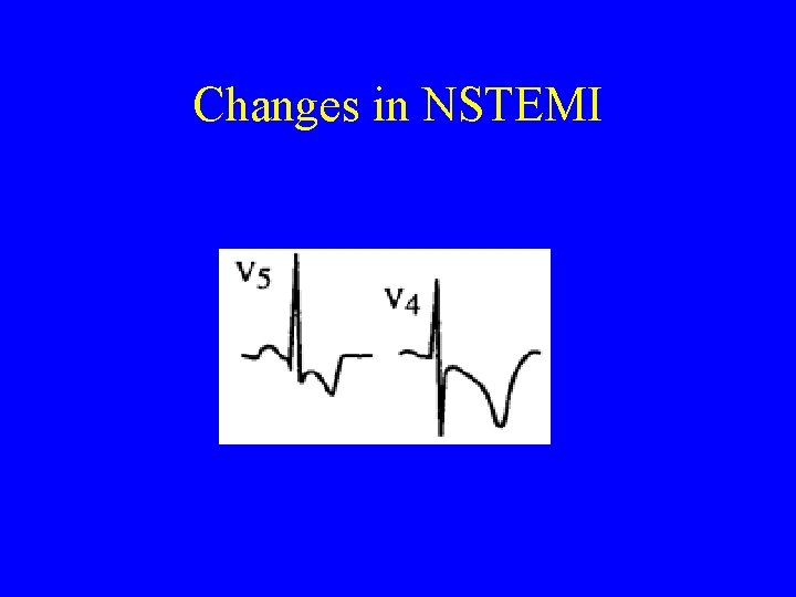 Changes in NSTEMI 