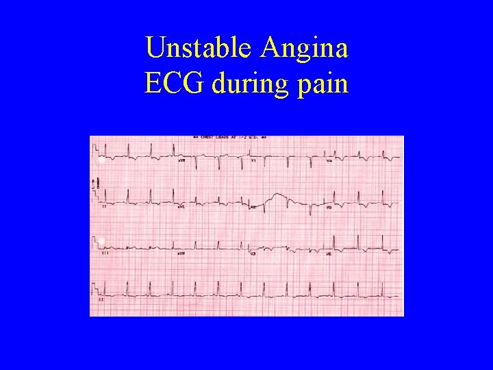 Unstable Angina ECG during pain 