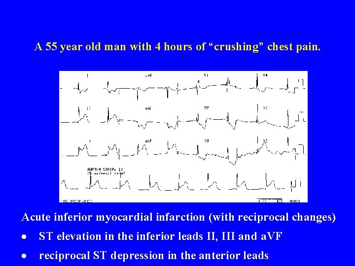 A 55 year old man with 4 hours of “crushing” chest pain. Acute inferior