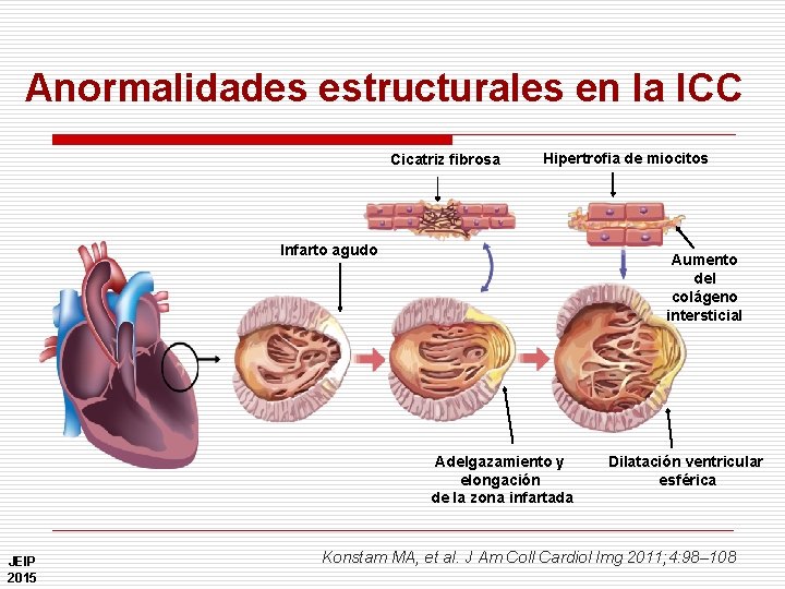 Anormalidades estructurales en la ICC Cicatriz fibrosa Hipertrofia de miocitos Infarto agudo Aumento del