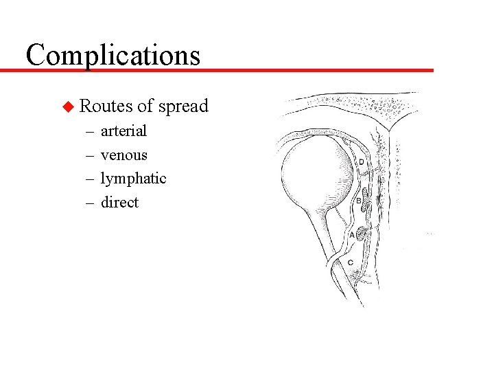 Complications u Routes – – of spread arterial venous lymphatic direct 