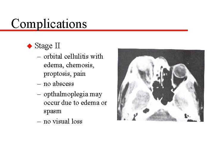 Complications u Stage II – orbital cellulitis with edema, chemosis, proptosis, pain – no