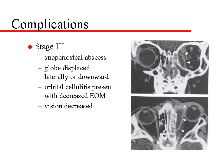 Complications u Stage III – subperiosteal abscess – globe displaced laterally or downward –