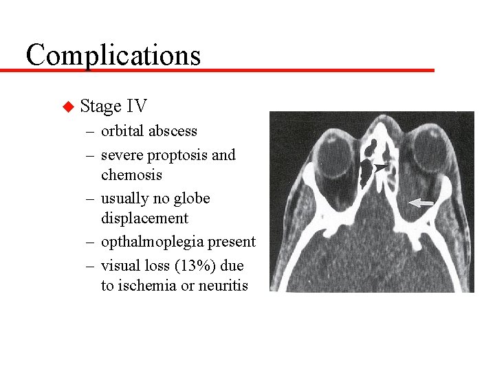 Complications u Stage IV – orbital abscess – severe proptosis and chemosis – usually