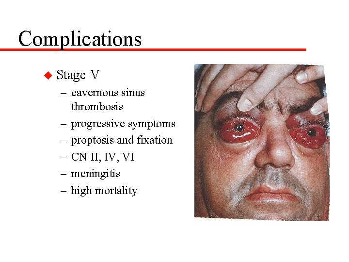 Complications u Stage V – cavernous sinus thrombosis – progressive symptoms – proptosis and