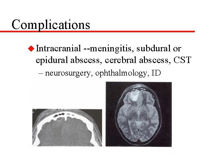 Complications u Intracranial --meningitis, subdural or epidural abscess, cerebral abscess, CST – neurosurgery, ophthalmology,