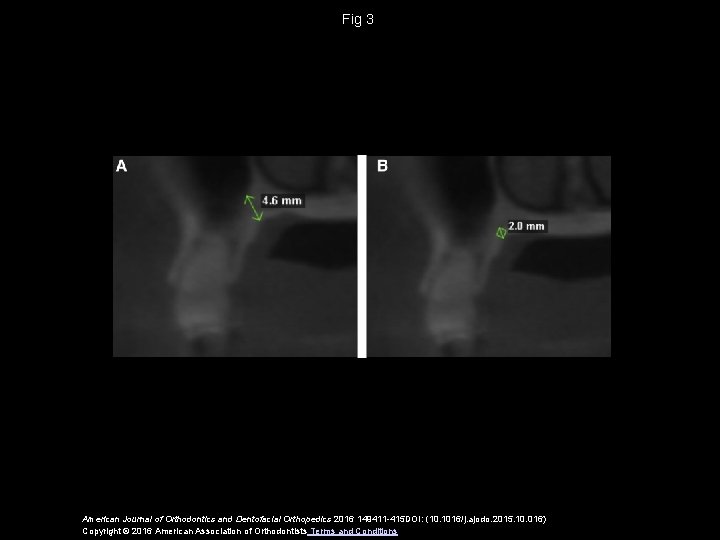 Fig 3 American Journal of Orthodontics and Dentofacial Orthopedics 2016 149411 -415 DOI: (10.