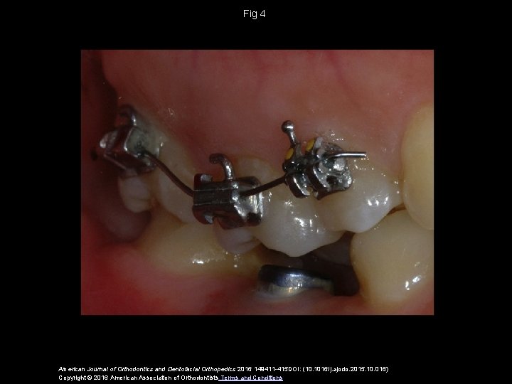 Fig 4 American Journal of Orthodontics and Dentofacial Orthopedics 2016 149411 -415 DOI: (10.