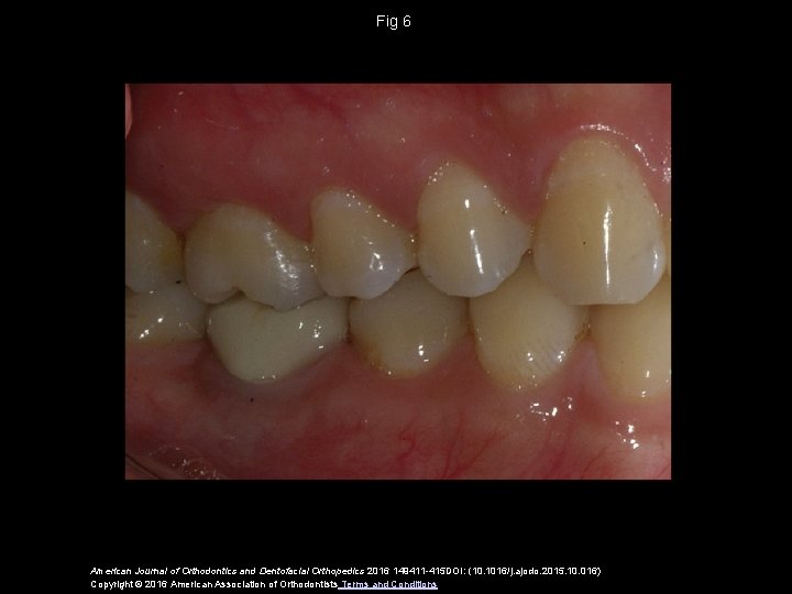 Fig 6 American Journal of Orthodontics and Dentofacial Orthopedics 2016 149411 -415 DOI: (10.