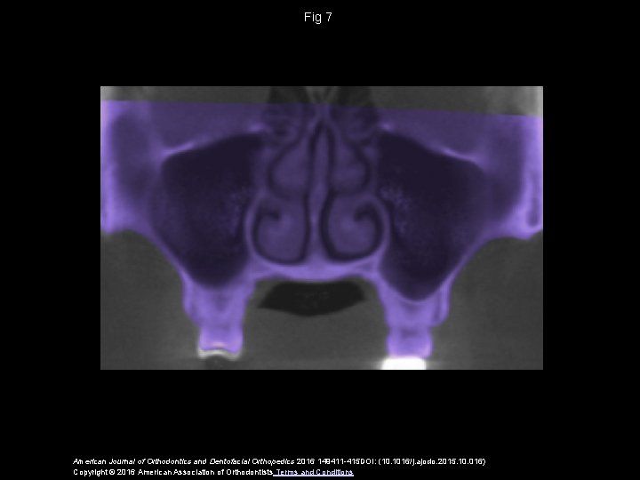 Fig 7 American Journal of Orthodontics and Dentofacial Orthopedics 2016 149411 -415 DOI: (10.