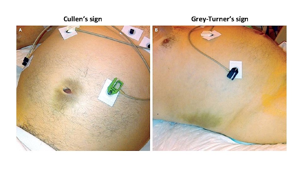 Cullen’s sign Grey-Turner’s sign 